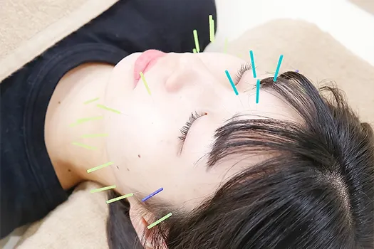 美顔鍼